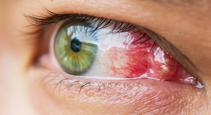 Cirugía de Pterigión (Carnosidad)