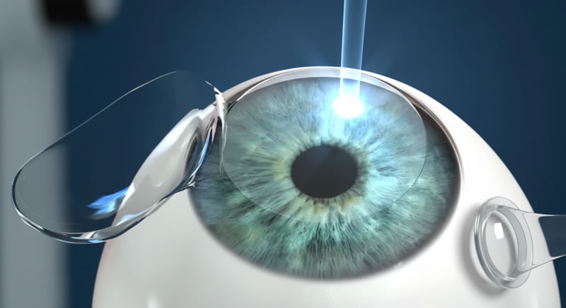 Cirugía LASIK